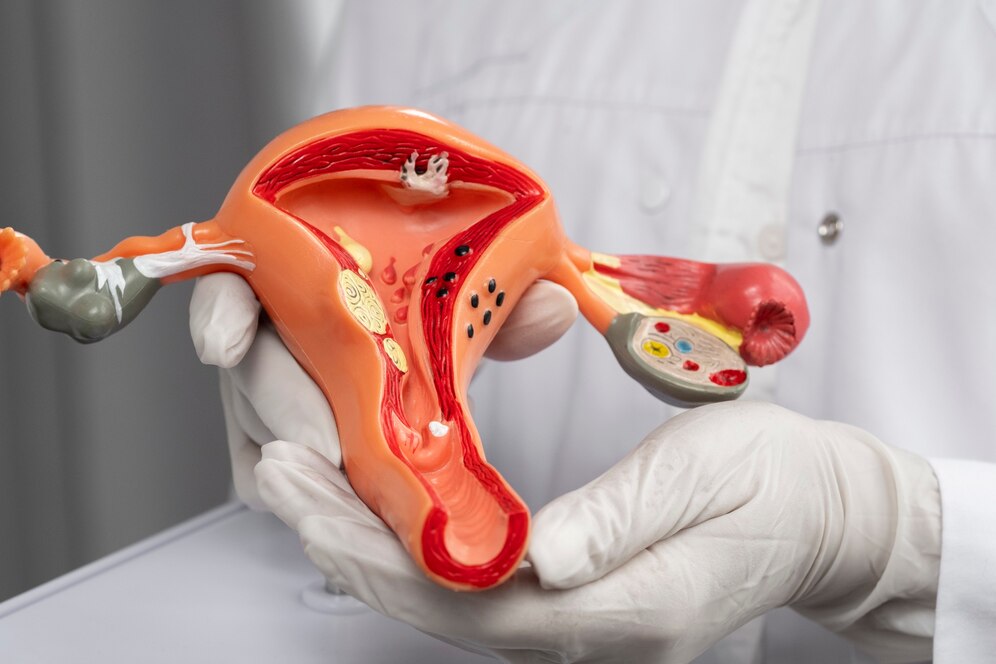 Endometriosis at Shree Shreeji Hospital, the Leading Gynecology Center in Gota