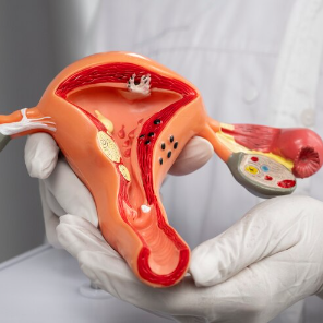 Ovarian Cyst Treatment In Gota Ahmedabad