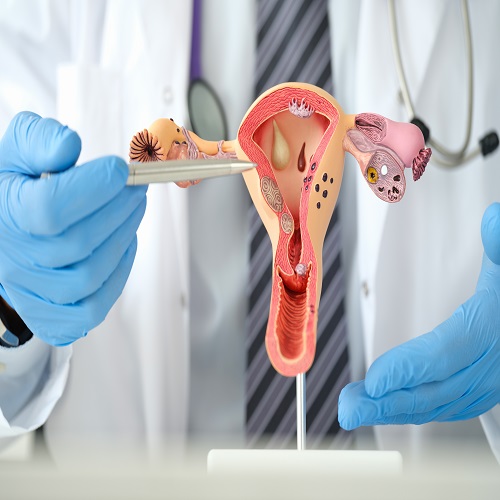 Gynec Onco Dept. Cervical Cancer & Treatment In Gota Ahmedabad