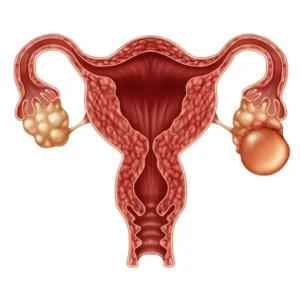 ovarian cyst
